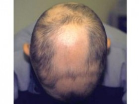 头发掉的厉害预示身体有什么病